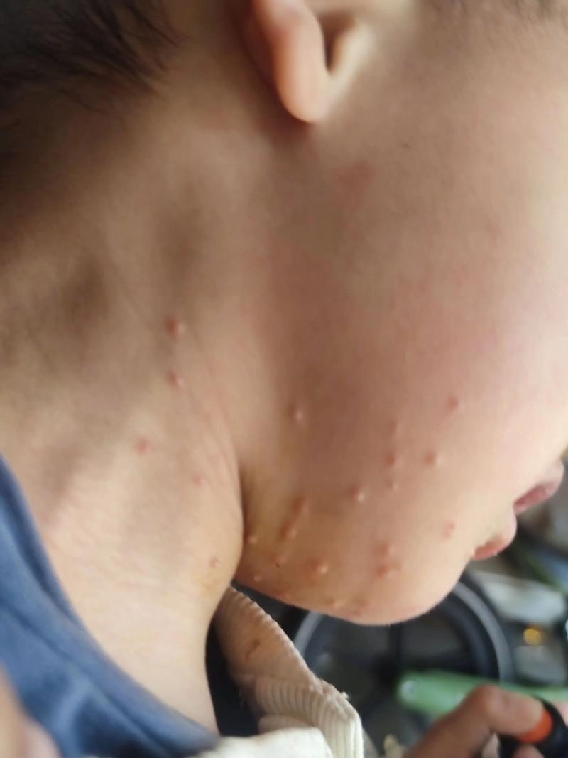 儿童心肌炎早期症状隐匿，家长该如何识别这些危险信号？-第3张图片-郑州医学网