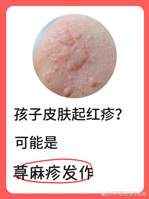 儿童过敏性皮炎治疗，如何科学用药与日常护理双管齐下？-第1张图片-郑州医学网