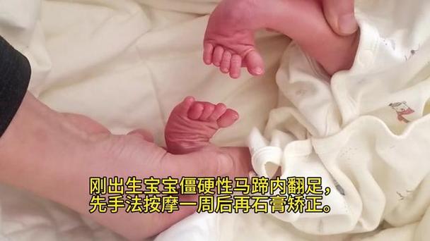 新生儿足内翻能自行恢复吗？需要治疗吗？会影响走路吗？-第2张图片-郑州医学网