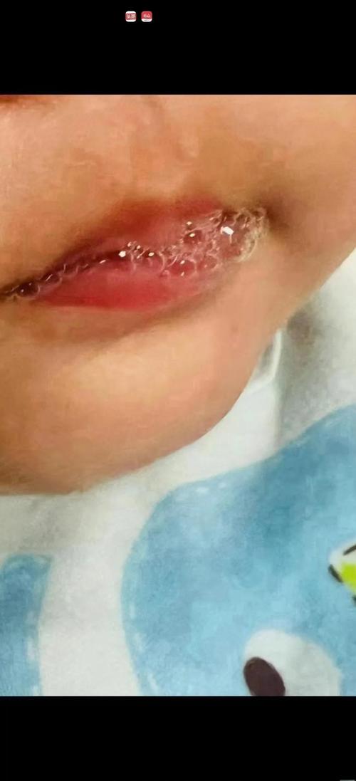 新生儿大便出现泡沫状是消化不良还是感染信号？-第3张图片-郑州医学网