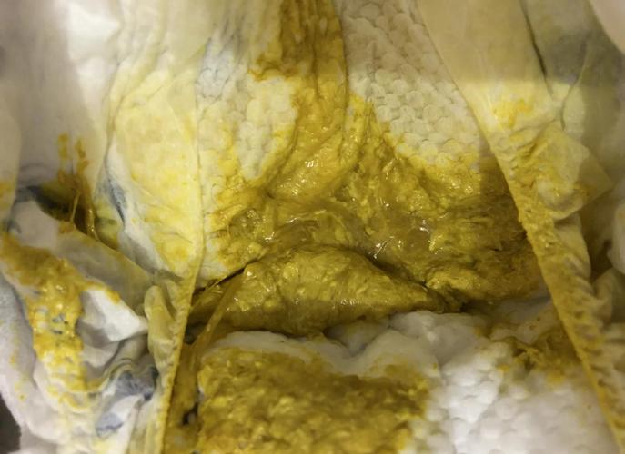 新生儿拉稀奶瓣和黄水-第1张图片-郑州医学网