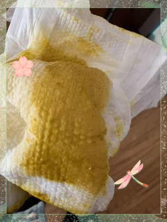 新生儿拉稀奶瓣和黄水-第2张图片-郑州医学网