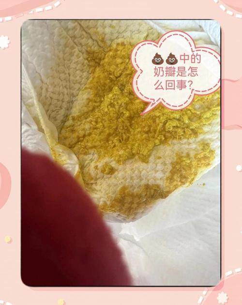 新生儿拉稀奶瓣和黄水-第3张图片-郑州医学网