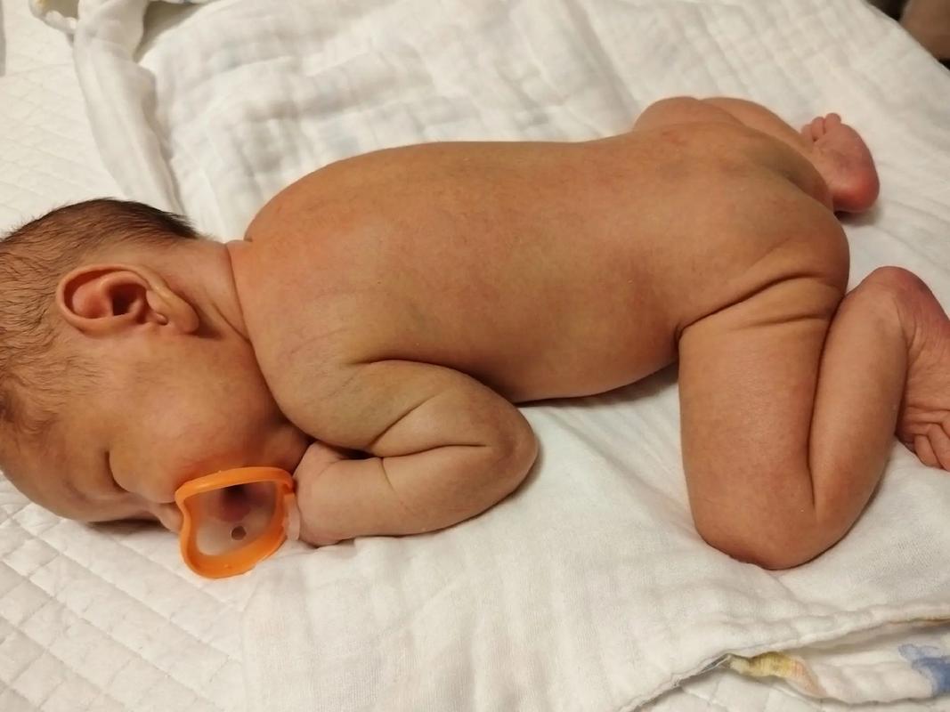 新生儿第六天黄疸16mg/dl需要立即干预吗？对宝宝有影响吗？-第2张图片-郑州医学网