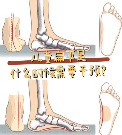 儿童扁平足矫正有哪些科学方法？不同年龄段矫正方案有何差异？-第2张图片-郑州医学网