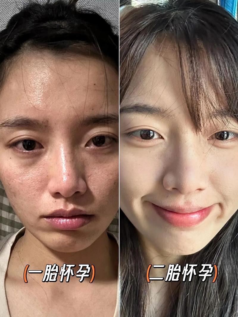 孕期皮肤差生完宝宝后，皮肤状态会自然恢复吗？需要做些什么来帮助改善呢？-第1张图片-郑州医学网