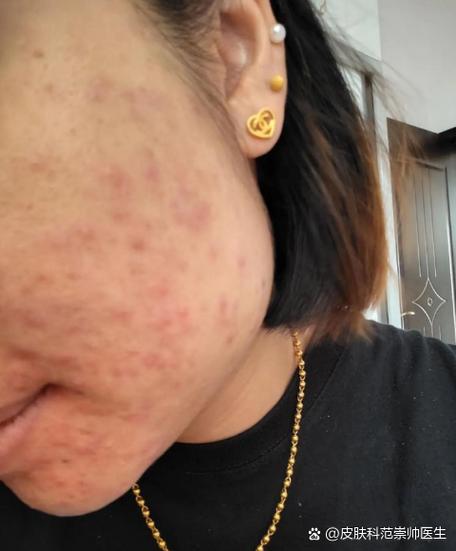 孕期皮肤差生完宝宝后，皮肤状态会自然恢复吗？需要做些什么来帮助改善呢？-第2张图片-郑州医学网