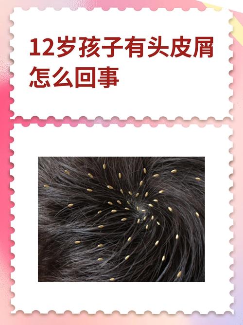 儿童头皮屑的成因是什么？与成人头皮屑有何不同？如何正确处理和预防？-第1张图片-郑州医学网