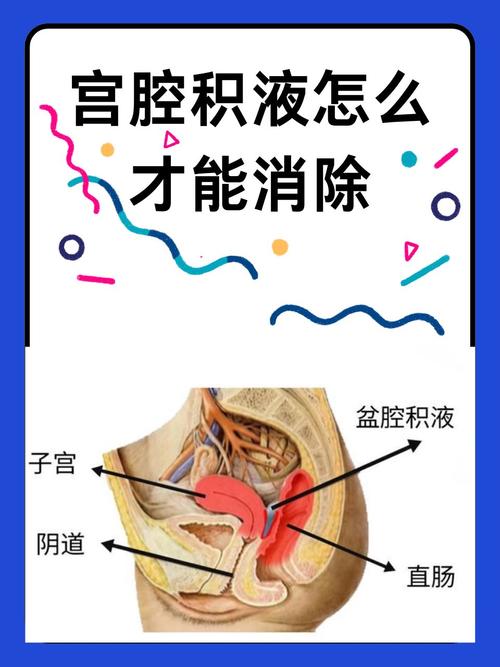 孕期积液会自行流出吗？对胎儿有影响吗？需要怎么处理？-第1张图片-郑州医学网