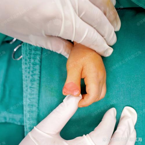 新生儿无名指比中指长，是发育异常还是隐藏的健康信号？-第1张图片-郑州医学网