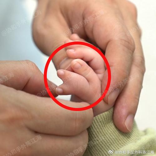 新生儿无名指比中指长，是发育异常还是隐藏的健康信号？-第2张图片-郑州医学网