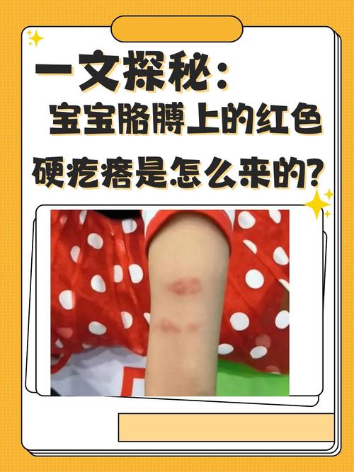 新生儿硬肿症能否自愈？不治疗会有哪些风险？-第1张图片-郑州医学网