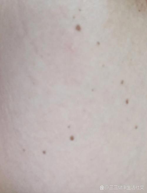 孕期身上突然冒出很多小痣，是激素变化还是健康预警？需要担心吗？-第1张图片-郑州医学网
