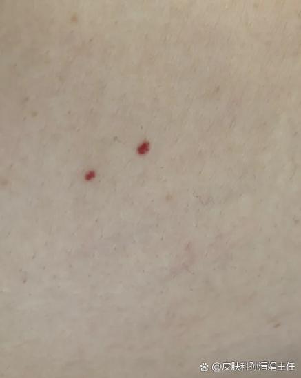 孕期身上突然冒出很多小痣，是激素变化还是健康预警？需要担心吗？-第3张图片-郑州医学网
