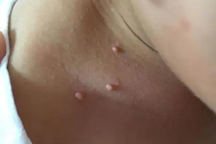 新生儿胸前长的小肉粒是什么?需要治疗吗?会自己消失吗?-第1张图片-郑州医学网 新生儿胸前长的小肉粒是什么?需要治疗吗?会自己消失吗?-第1张图片-郑州医学网