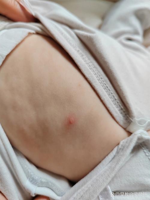 新生儿胸前长的小肉粒是什么？需要治疗吗？会自己消失吗？-第2张图片-郑州医学网