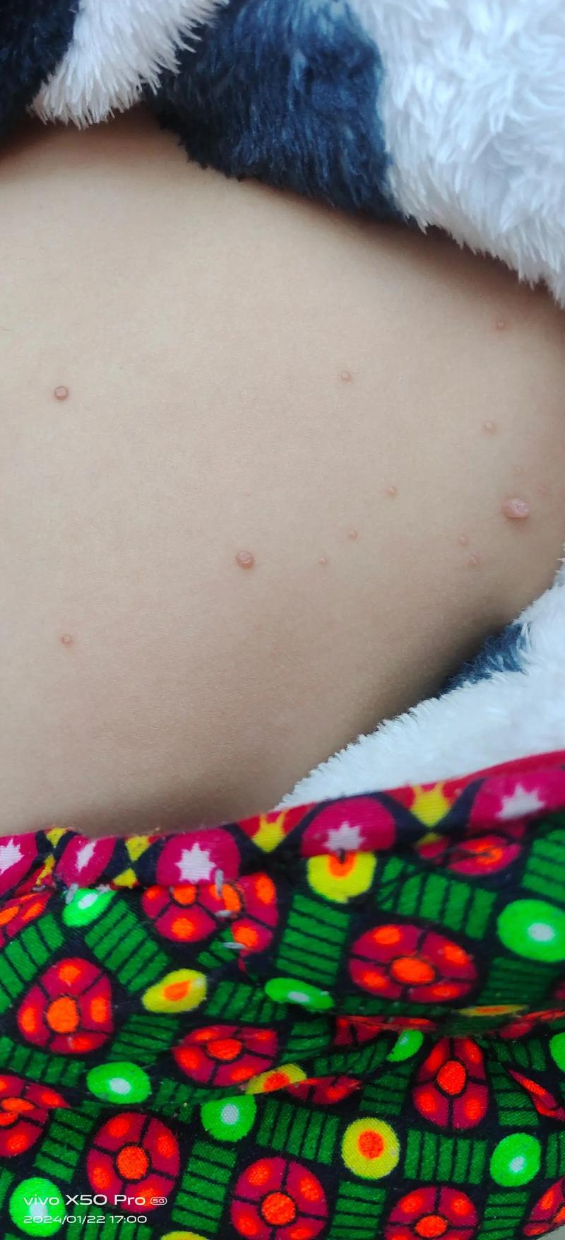 新生儿胸前长的小肉粒是什么?需要治疗吗?会自己消失吗?-第3张图片-郑州医学网 新生儿胸前长的小肉粒是什么?需要治疗吗?会自己消失吗?-第3张图片-郑州医学网