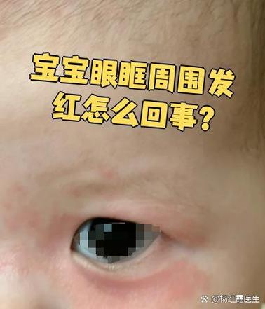 儿童眼圈发红是过敏还是疾病信号？家长该如何应对与护理？-第1张图片-郑州医学网