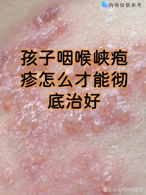 儿童口腔疱疹几天能好-第1张图片-郑州医学网