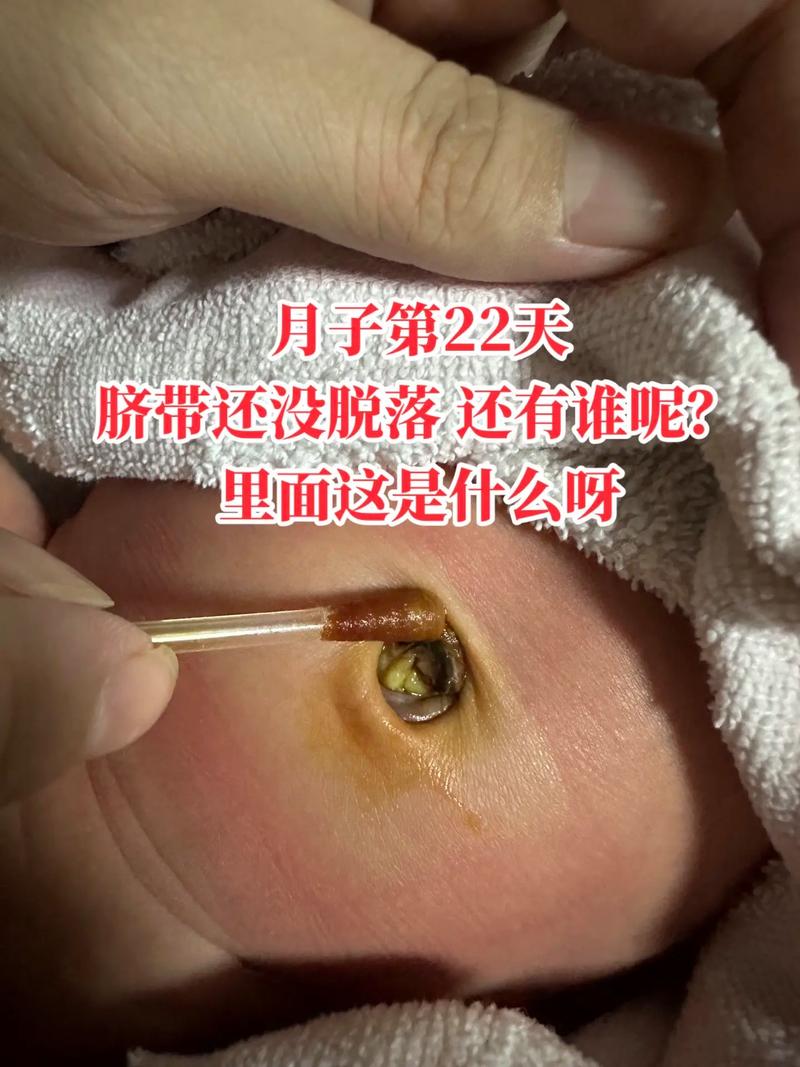 新生儿半个月脐带没掉-第1张图片-郑州医学网 新生儿半个月脐带没掉-第1张图片-郑州医学网