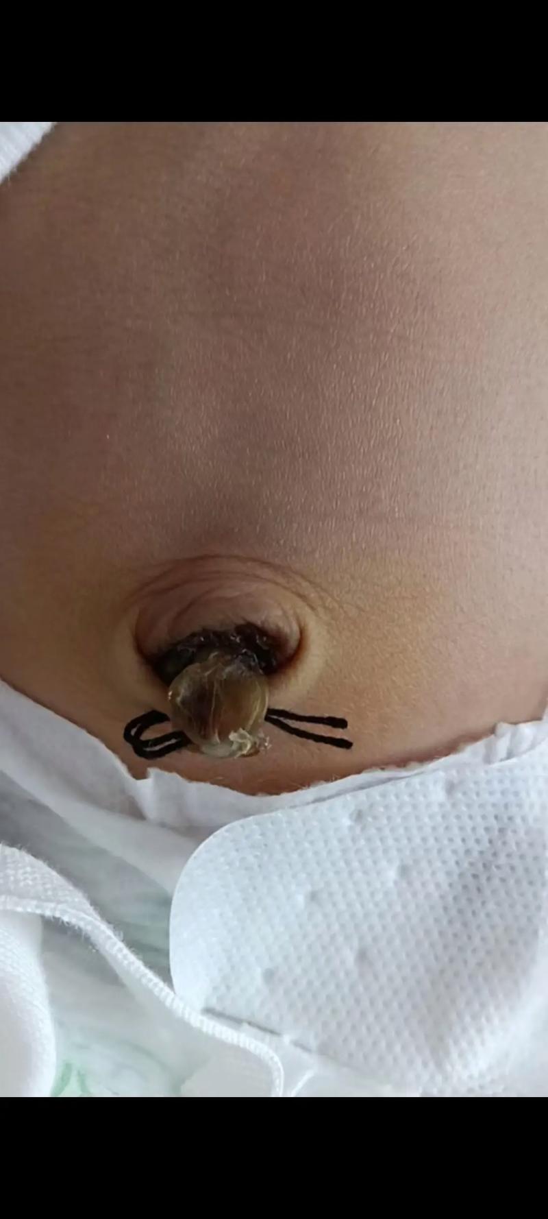 新生儿半个月脐带没掉-第2张图片-郑州医学网