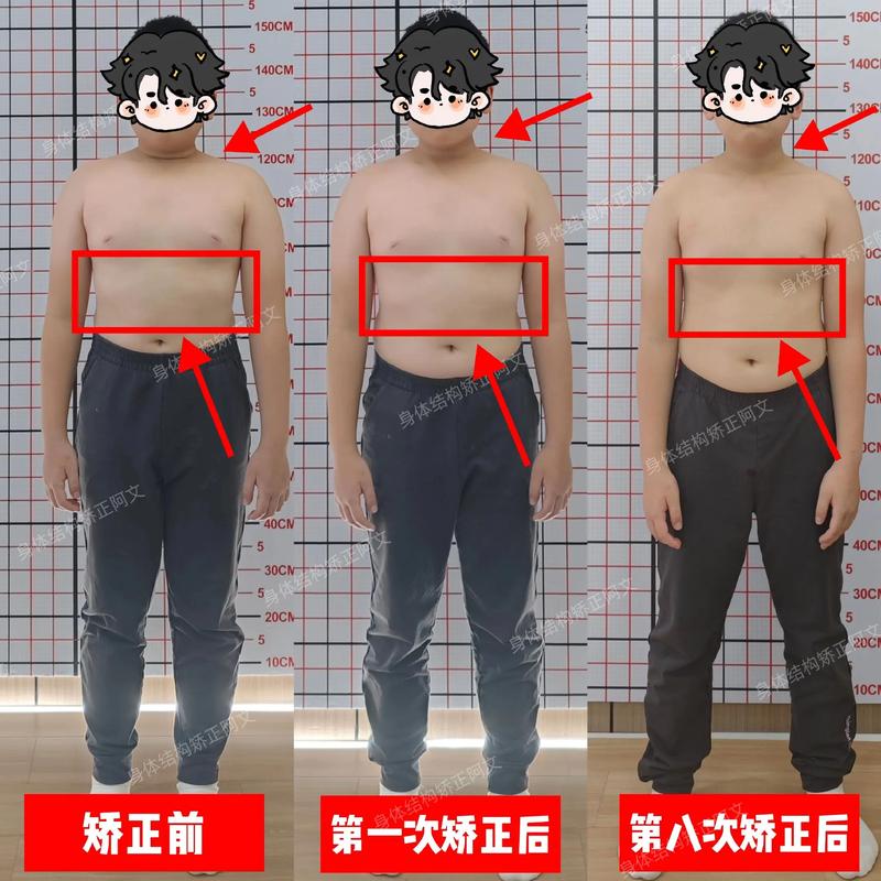 儿童肋骨外翻挂什么科-第3张图片-郑州医学网