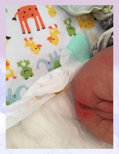 新生儿屁眼上面一个坑-第1张图片-郑州医学网