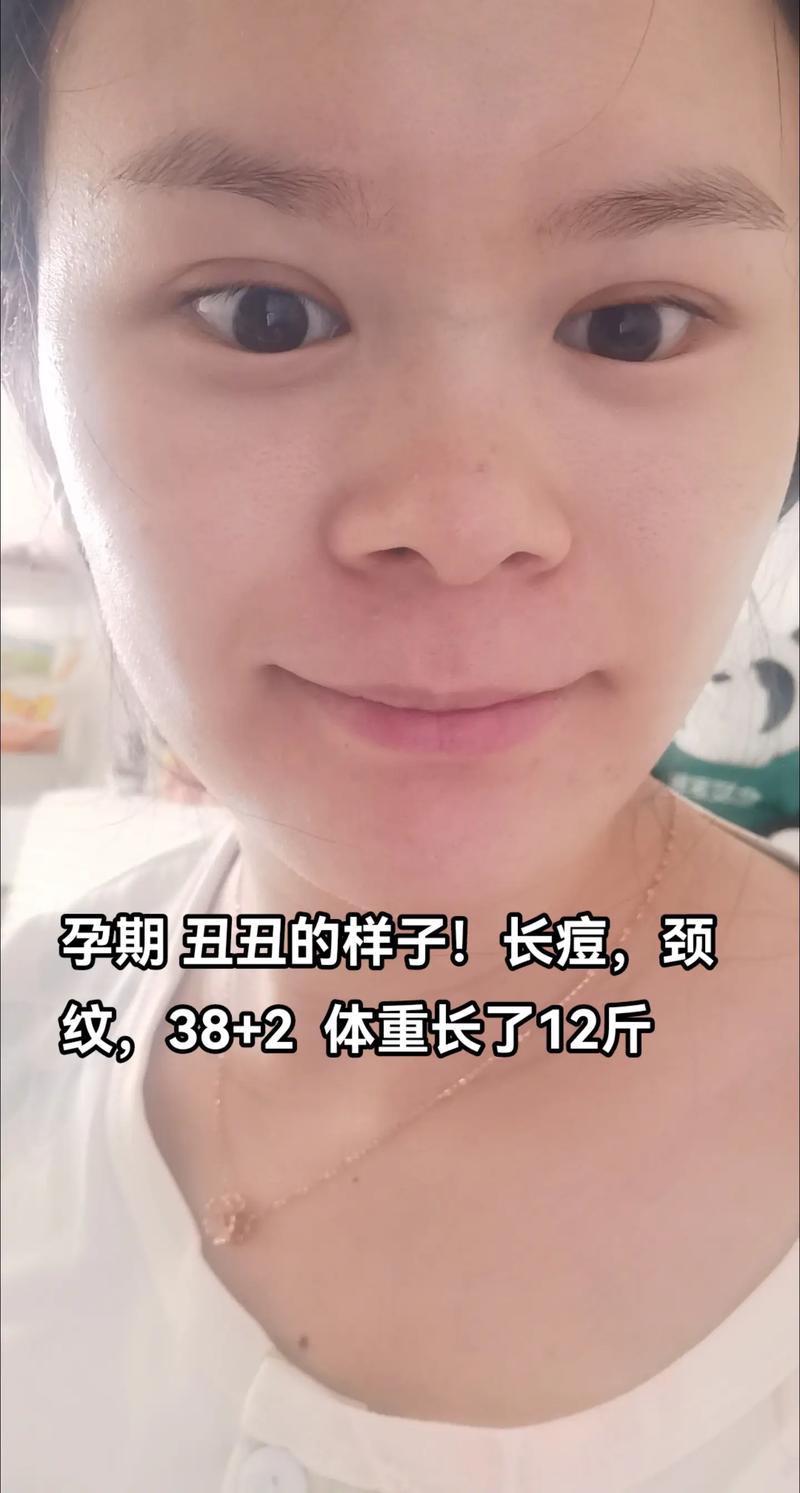 孕期皮肤变差是女孩吗-第2张图片-郑州医学网