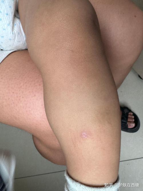 儿童皮肤真菌感染图片有哪些典型症状及如何正确识别与处理？-第3张图片-郑州医学网