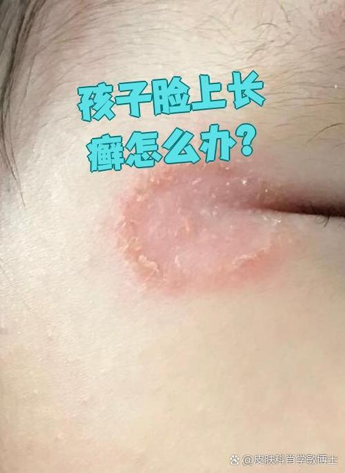 儿童皮肤真菌感染图片有哪些典型症状及如何正确识别与处理？-第2张图片-郑州医学网