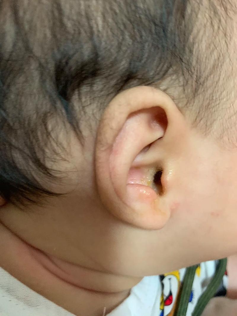 孩子耳朵流黄水是中耳炎吗？家长该如何正确处理与护理？-第2张图片-郑州医学网