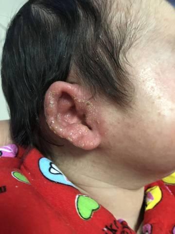 孩子耳朵流黄水是中耳炎吗？家长该如何正确处理与护理？-第3张图片-郑州医学网