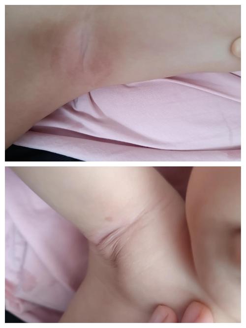 新生儿胳肢窝有白色泡-第1张图片-郑州医学网