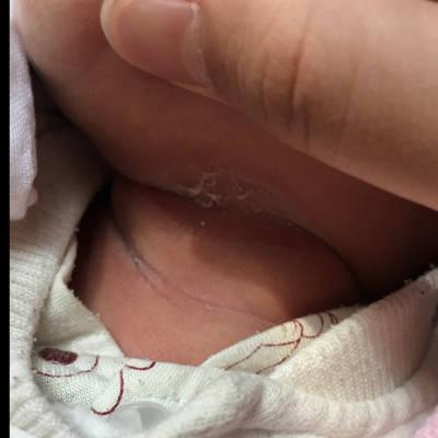 新生儿胳肢窝有白色泡-第3张图片-郑州医学网