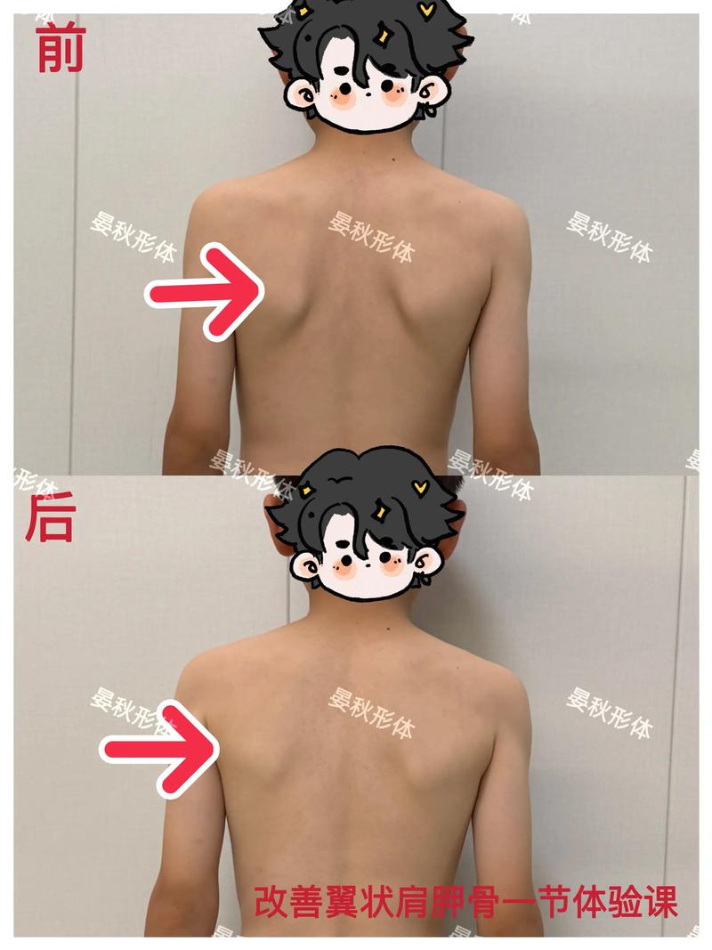 儿童肩胛骨突出是正常现象还是疾病信号？家长该如何科学干预？-第1张图片-郑州医学网