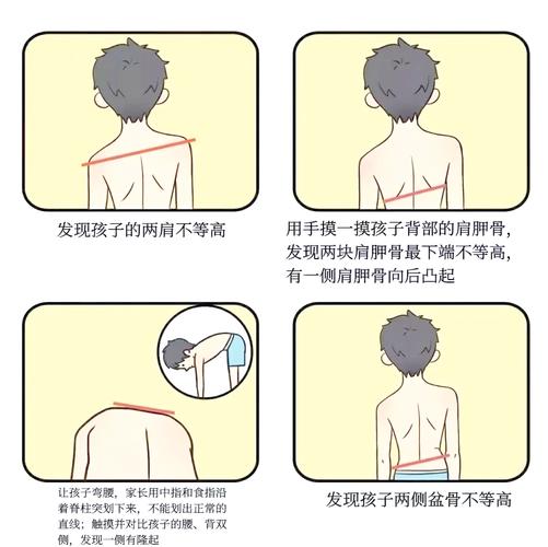 儿童肩胛骨突出是正常现象还是疾病信号？家长该如何科学干预？-第3张图片-郑州医学网