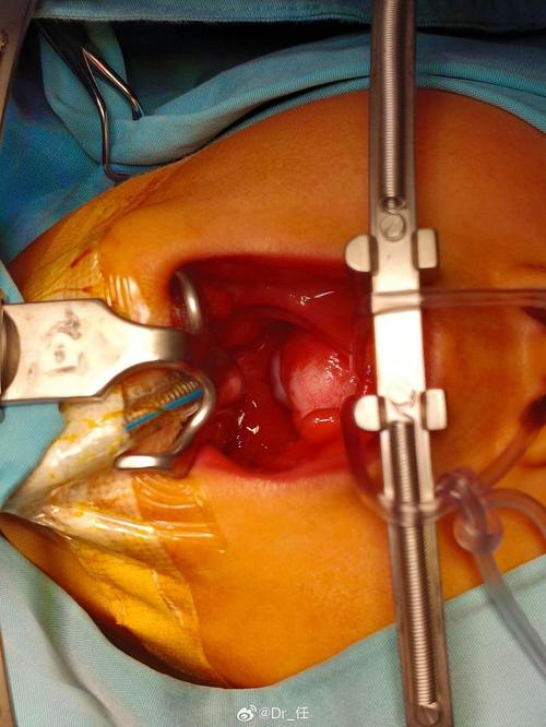 儿童腺样体手术具体怎么做？需要全麻吗？术后恢复要注意什么？-第2张图片-郑州医学网