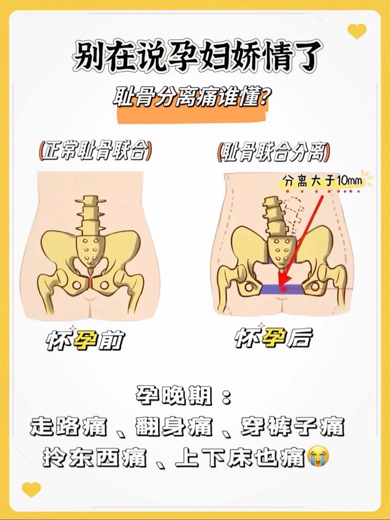 孕期耻骨疼到坐立难安，到底该怎么缓解才能不影响日常？-第3张图片-郑州医学网