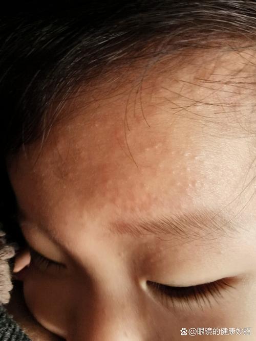 新生儿脑门上长小疙瘩是什么原因？需要担心吗？-第1张图片-郑州医学网