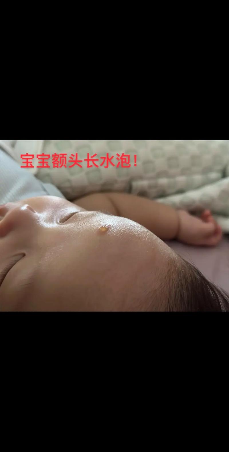 新生儿脑门上长小疙瘩是什么原因？需要担心吗？-第3张图片-郑州医学网