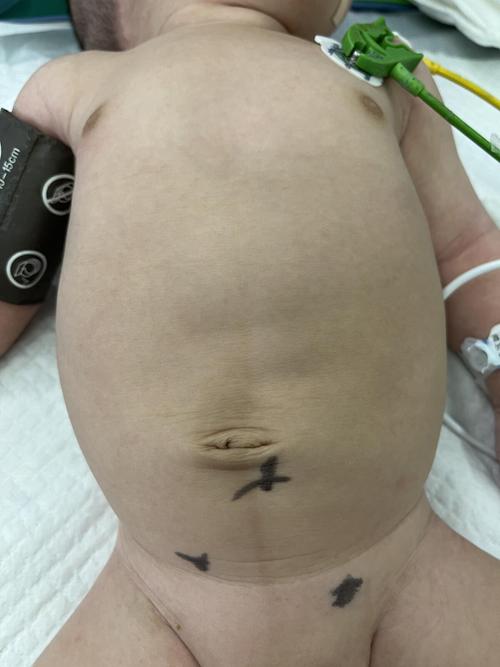 新生儿巨结肠到底有多危险？不及时治疗会影响孩子一生吗？-第2张图片-郑州医学网