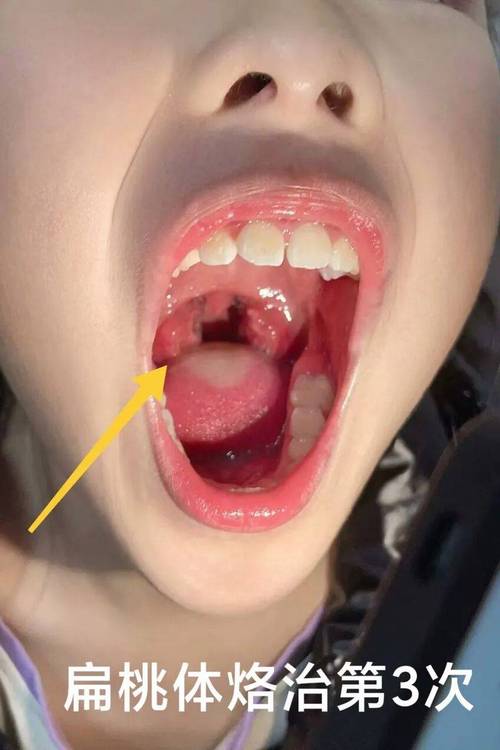 儿童扁桃体发炎图片能准确判断病情吗？不同症状该如何区分？-第1张图片-郑州医学网