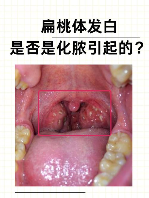 儿童扁桃体发炎图片能准确判断病情吗？不同症状该如何区分？-第2张图片-郑州医学网