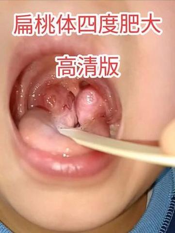 儿童扁桃体发炎图片能准确判断病情吗？不同症状该如何区分？-第3张图片-郑州医学网