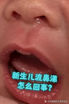 新生儿10天流黄鼻涕是正常现象还是感染信号？需警惕哪些潜在问题？-第1张图片-郑州医学网