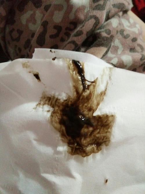 孕期宫颈息肉导致白带褐色，是否需要立即就医？对胎儿有影响吗？-第3张图片-郑州医学网