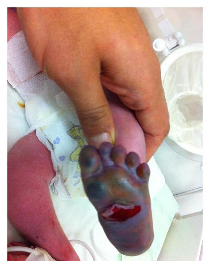 新生儿败血症有哪些典型症状？通过图片解析如何早期识别这种危险的感染信号？-第1张图片-郑州医学网