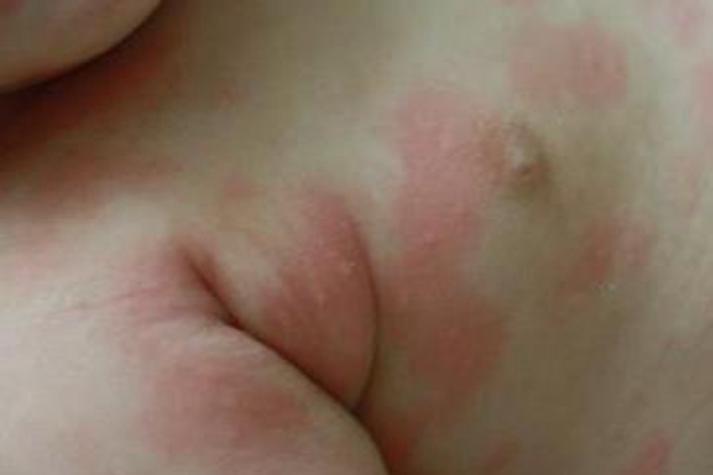 新生儿败血症有哪些典型症状？通过图片解析如何早期识别这种危险的感染信号？-第3张图片-郑州医学网