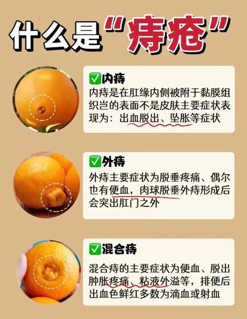 孕期痔疮犯了怎么办？这5个安全缓解方法能试试吗？-第1张图片-郑州医学网