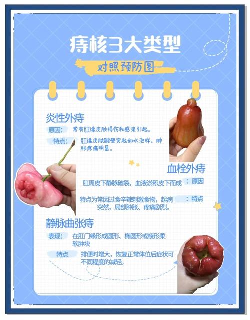 孕期痔疮犯了怎么办？这5个安全缓解方法能试试吗？-第3张图片-郑州医学网